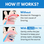 Anti Snoring Mouthpiece